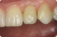 dental implant