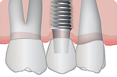 dental implant